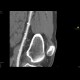 Distal anastomosis of femoro-popliteal bypass: CT - Computed tomography